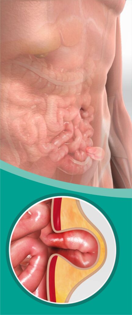 Laparoscopic Hernia Training